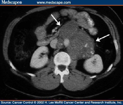 ST II-III Seminoma < 5 cm imusolmukkeet => sädehoito > 5 cm imusolmukkeet tai ST III => BEP x 3 Jos > 3cm residuaalituumori, suos FDG PET PET neg