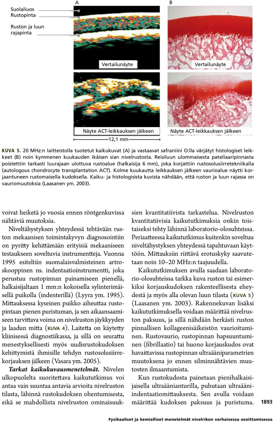 Reisiluun ulommaisesta patellaaripinnasta poistettiin tarkasti luurajaan ulottuva rustoalue (halkaisija 6 mm), joka korjattiin rustosolusiirretekniikalla (autologous chondrocyte transplantation ACT).