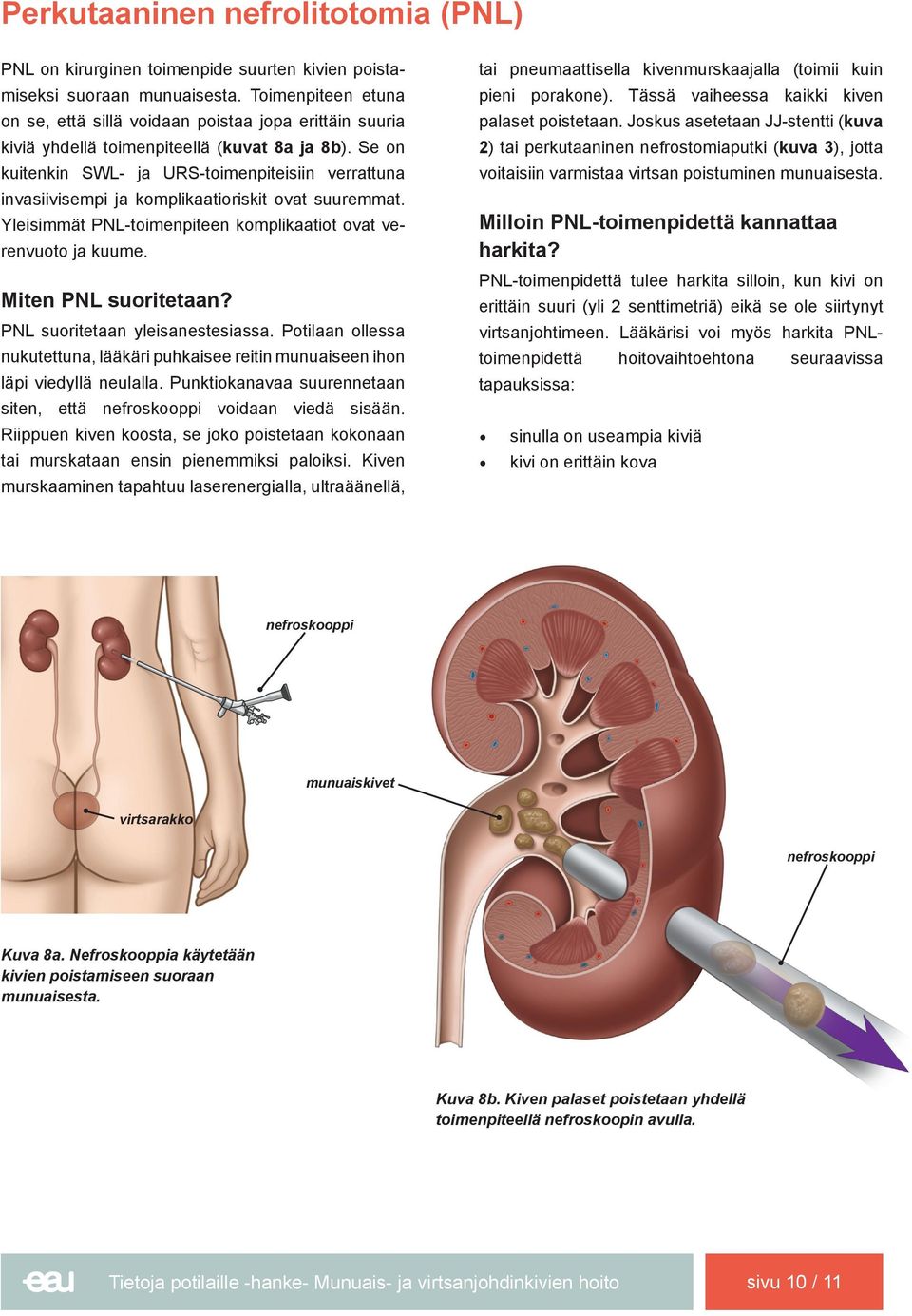 Se on kuitenkin SWL- ja URS-toimenpiteisiin verrattuna invasiivisempi ja komplikaatioriskit ovat suuremmat. Yleisimmät PNL-toimenpiteen komplikaatiot ovat verenvuoto ja kuume. Miten PNL suoritetaan?