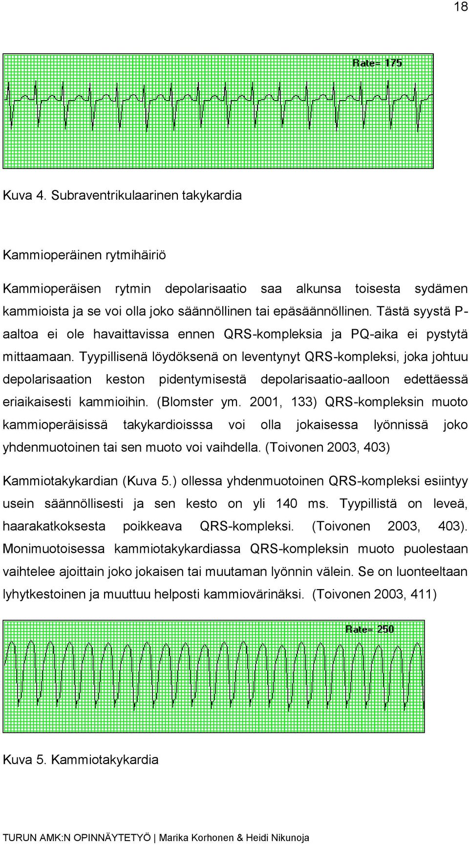 Tästä syystä P- aaltoa ei ole havaittavissa ennen QRS-kompleksia ja PQ-aika ei pystytä mittaamaan.