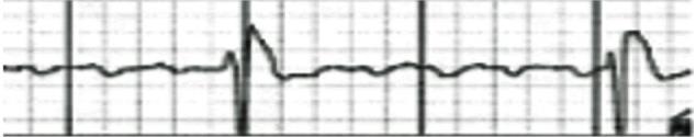 Tällöin rytmi on säännöllinen, QRS kompleksi on leveä, eikä siinä ole P-aaltoa (kuva 2), se voi myös esiintyä potilailla kohtauksittaisina, ja pitkään jatkuneena potilas yleensä menee tajuttomaksi.