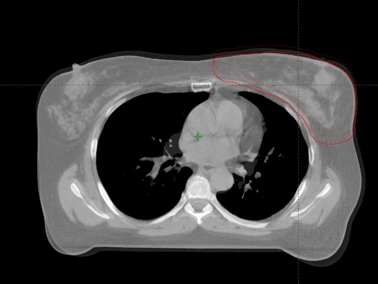 Hengitystahdistus: ABC =Active Breathing Coordinator Spirometri lukkiutuu syvässä sisäänhengityksessä Potilas epäsuorasti kontrolloi hoidon aloitusta