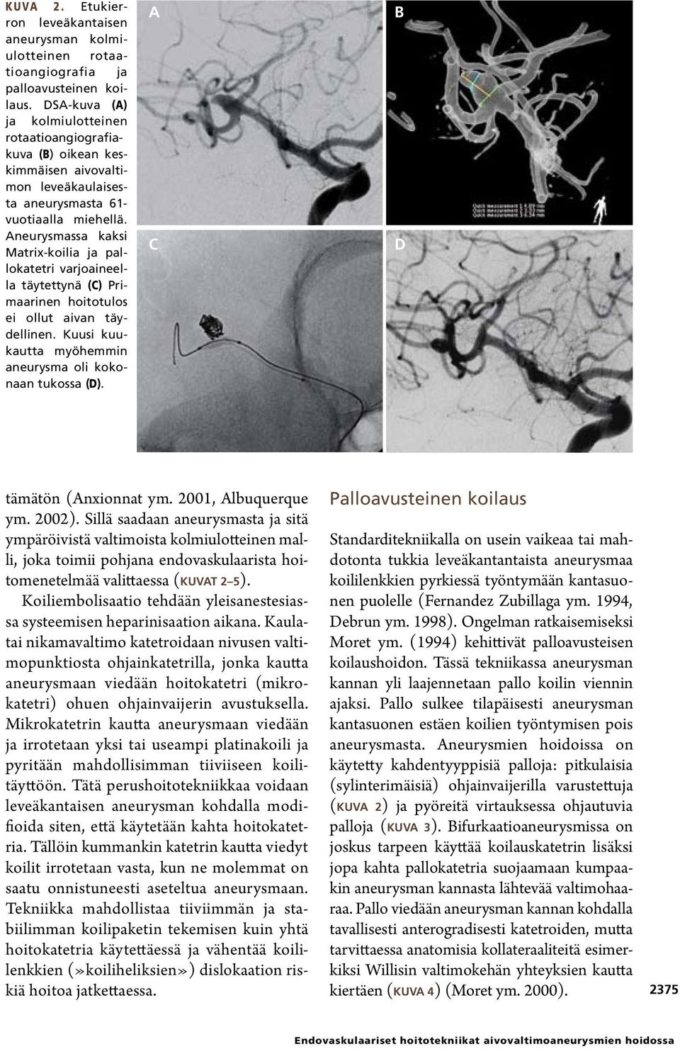 Aneurysmassa kaksi Matrix-koilia ja pallokatetri varjoaineella täytettynä (C) Primaarinen hoitotulos ei ollut aivan täydellinen. Kuusi kuukautta myöhemmin aneurysma oli kokonaan tukossa (D).