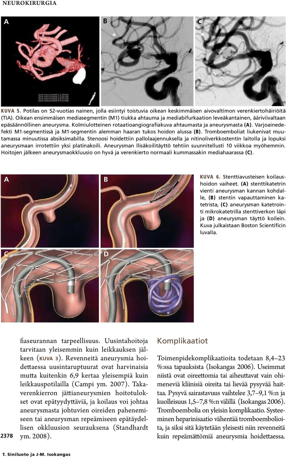 Kolmiulotteinen rotaatioangiografiakuva ahtaumasta ja aneurysmasta (A). Varjoainedefekti M1-segmentissä ja M1-segmentin alemman haaran tukos hoidon alussa (B).