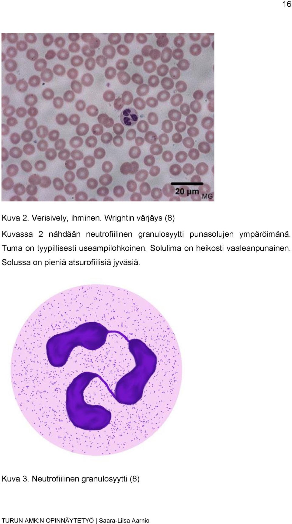 punasolujen ympäröimänä. Tuma on tyypillisesti useampilohkoinen.