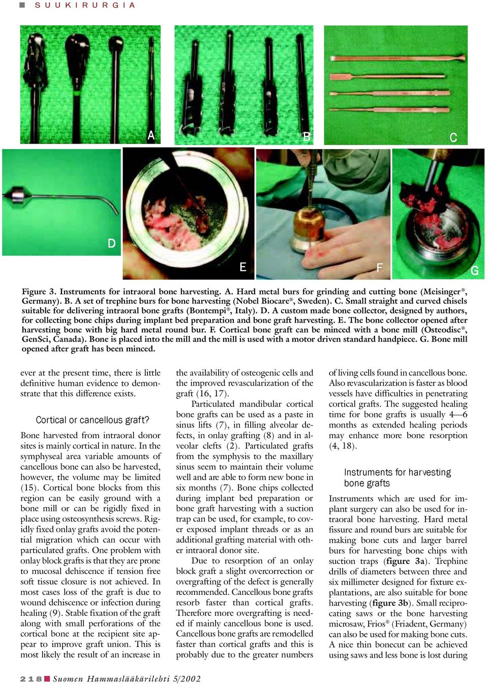A custom made bone collector, designed by authors, for collecting bone chips during implant bed preparation and bone graft harvesting. E.