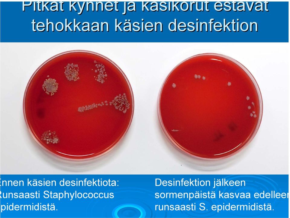 unsaasti Staphylococcus pidermidistä.