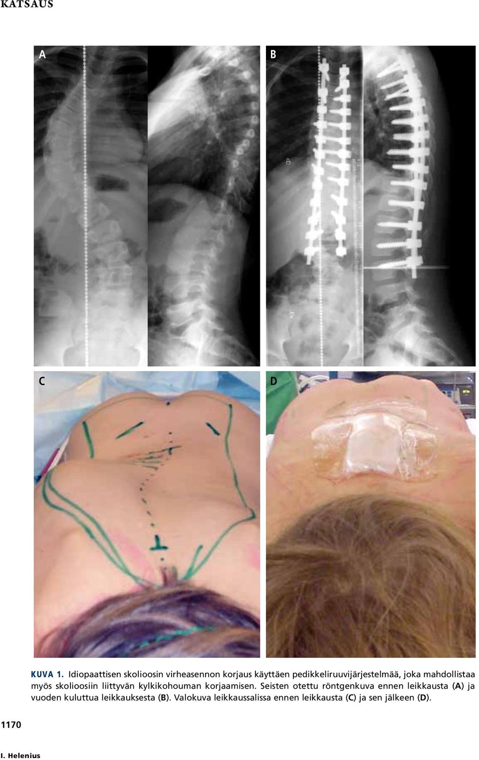 joka mahdollistaa myös skolioosiin liittyvän kylkikohouman korjaamisen.