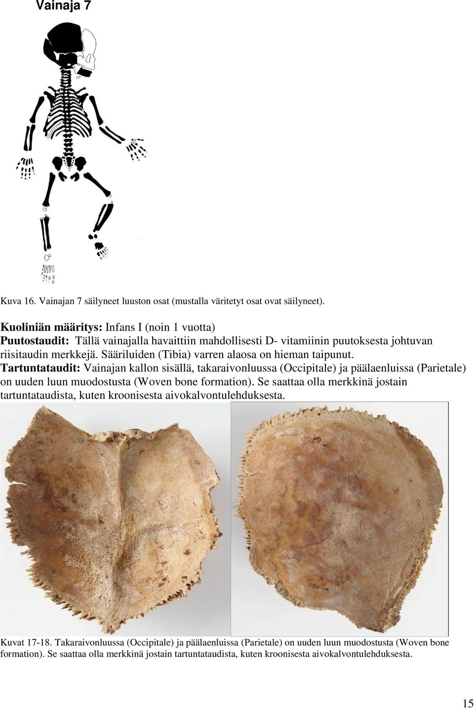 Sääriluiden (Tibia) varren alaosa on hieman taipunut.