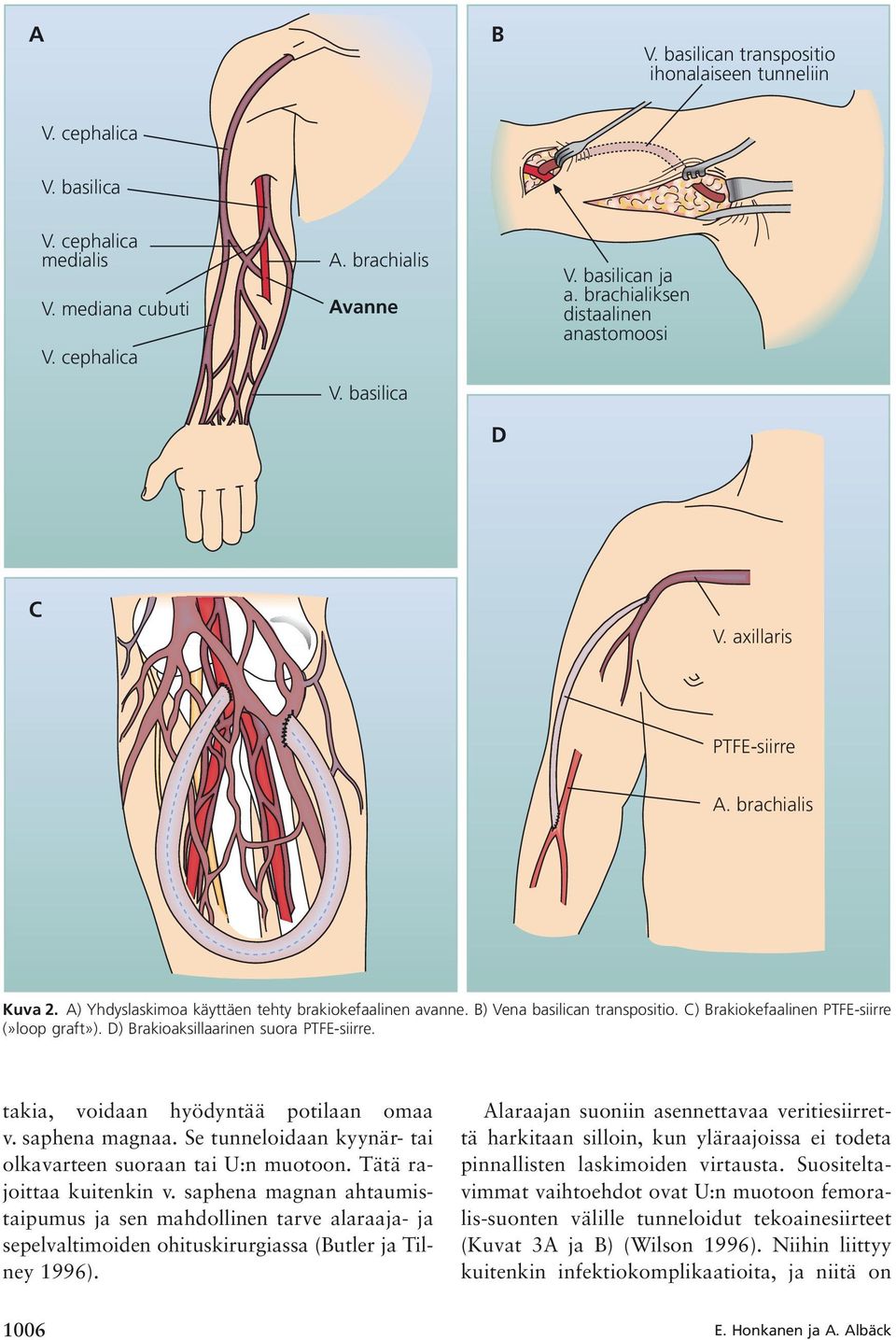 C) Brakiokefaalinen PTFE-siirre (»loop graft»). D) Brakioaksillaarinen suora PTFE-siirre. takia, voidaan hyödyntää potilaan omaa v. saphena magnaa.