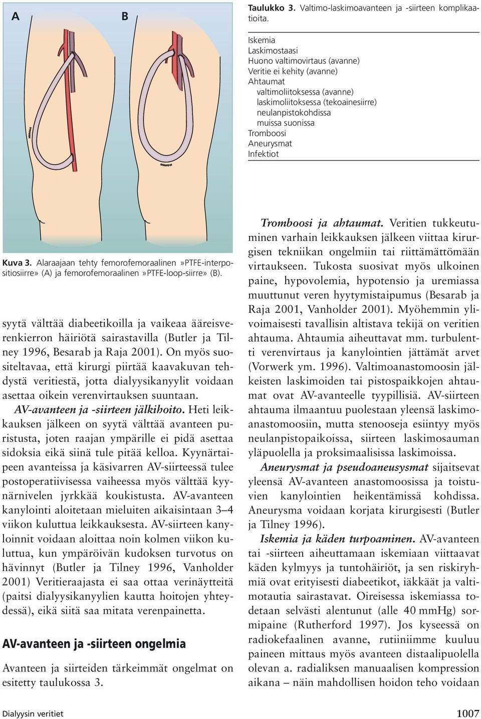 Aneurysmat Infektiot Kuva 3. Alaraajaan tehty femorofemoraalinen»ptfe-interpositiosiirre» (A) ja femorofemoraalinen»ptfe-loop-siirre» (B).