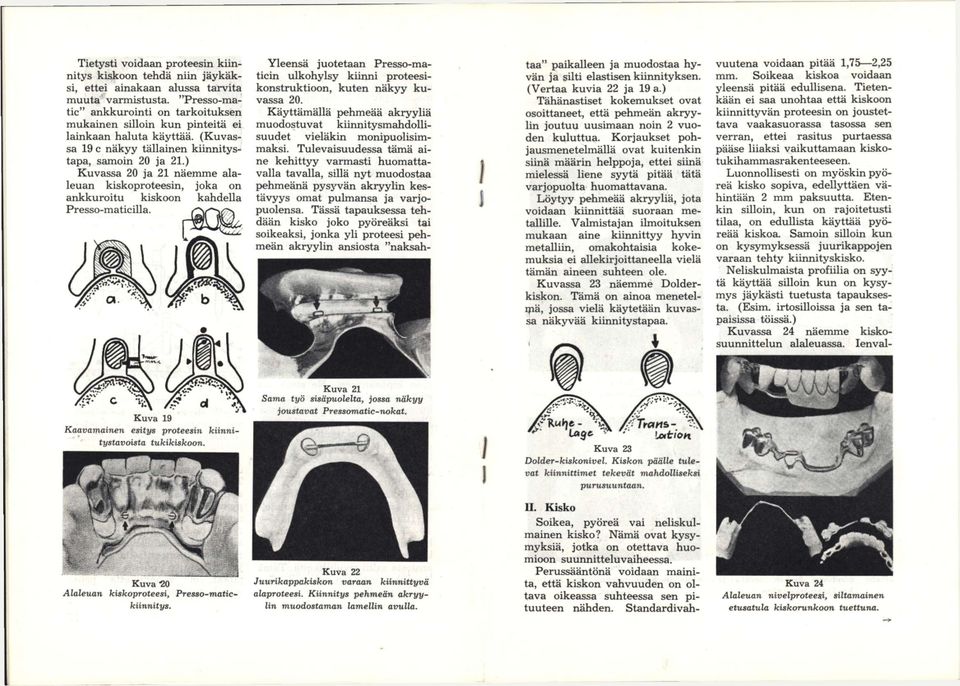 ) Kuvassa 20 ja 21 näemme alaleuan kiskoproteesin, joka on ankkuroitu kiskoon kahdella Yleensä juotetaan Presso-maticin ulkohylsy kiinni proteesikonstruktioon, kuten näkyy kuvassa 20.