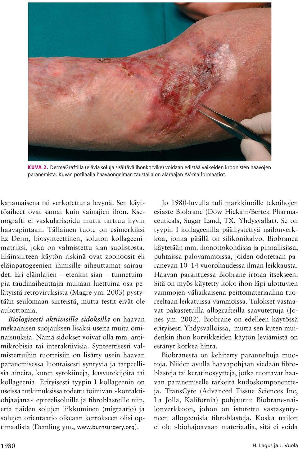 Tällainen tuote on esimerkiksi Ez Derm, biosynteettinen, soluton kollageenimatriksi, joka on valmistettu sian suolistosta.