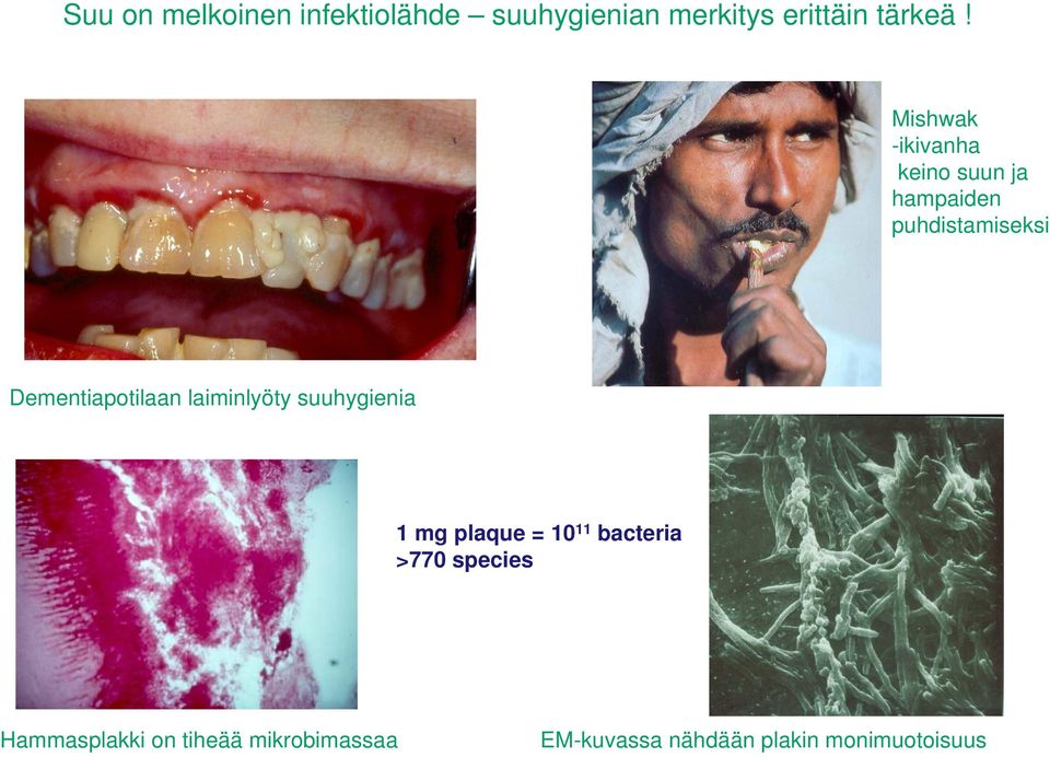 Dementiapotilaan laiminlyöty suuhygienia 1 mg plaque = 10 11 bacteria