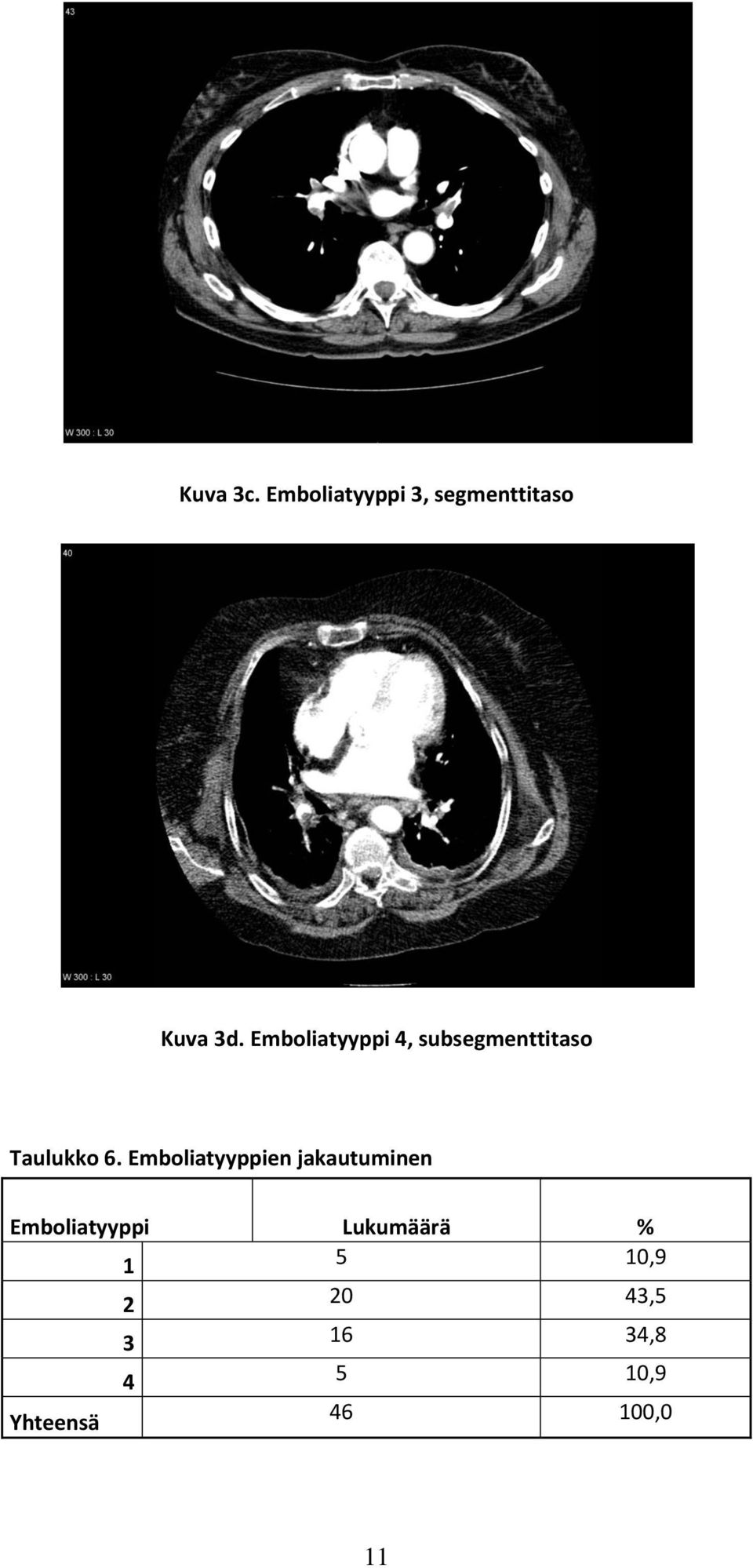 Emboliatyyppien jakautuminen Emboliatyyppi