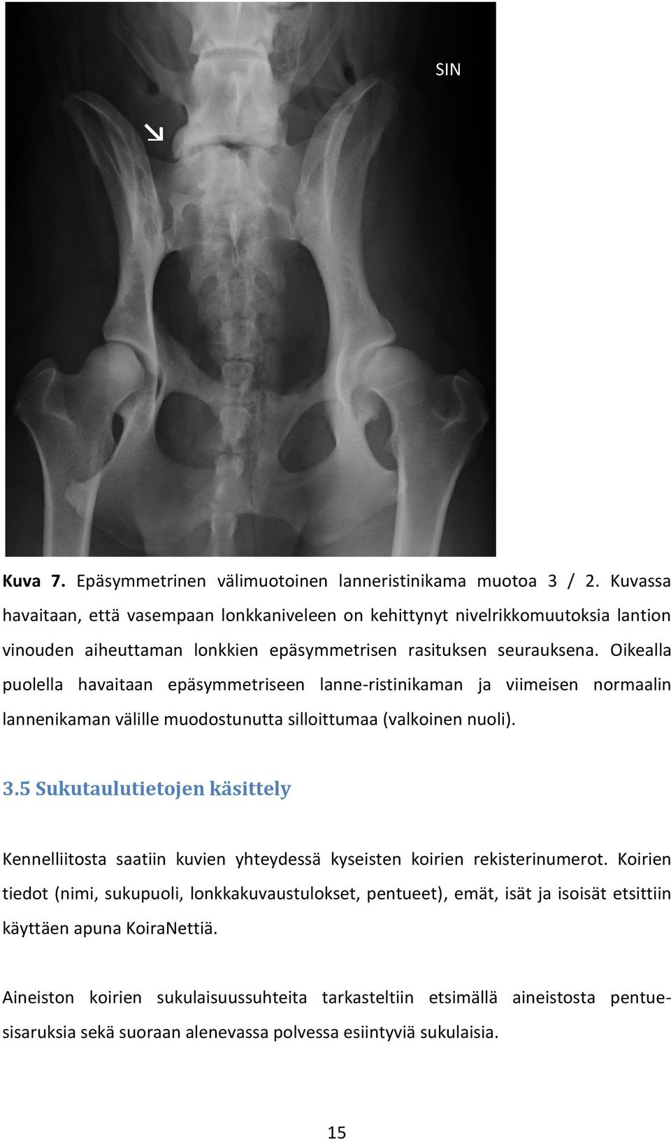 Oikealla puolella havaitaan epäsymmetriseen lanne-ristinikaman ja viimeisen normaalin lannenikaman välille muodostunutta silloittumaa (valkoinen nuoli). 3.