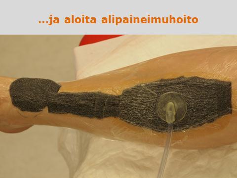 Alipaineimuhoito kahdelle