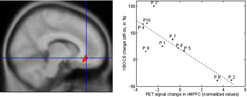 Figure 4. Correlation between metabolic change induced by stimulation and concomitant clinical improvement.