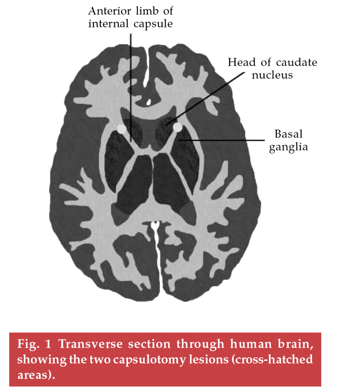 Transverse section through human brain, showing the two capsulotomy lesions (crosshatched