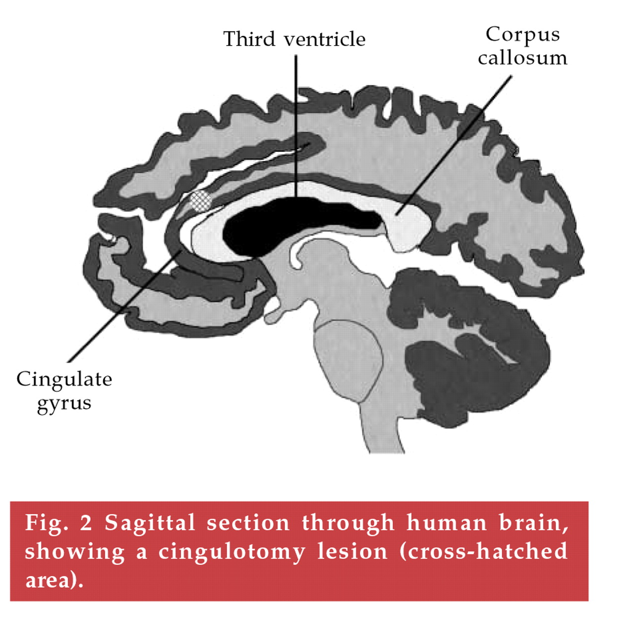 Sagittal section through human brain, showing a cingulotomy lesion (cross-hatched