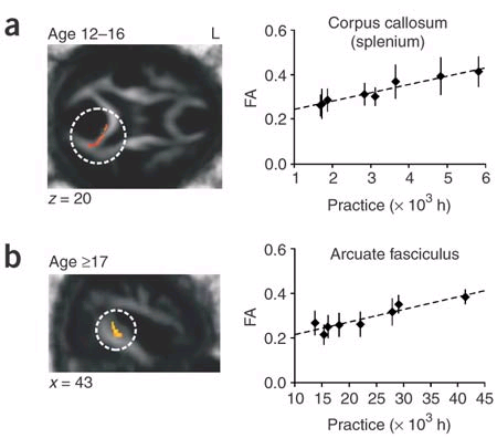 Effects of long- term musical activities In musicians, white matter tracts capsula interna (between motor areas and muscles), corpus