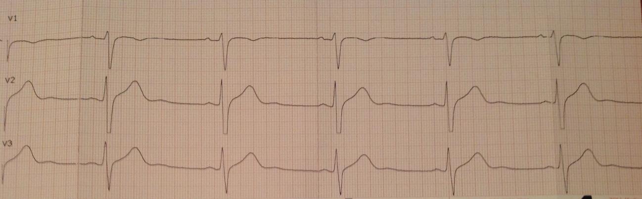 23 KUVA 4. Normaali 20-vuotiaan miehen EKG-käyrä. Kuvassa havaittavissa V2- ja V3- kytkennöissä ST-välin muutosta, joka johtuu varhaisesta repolarisaatiosta. V1- kytkennässä negatiivinen T-aalto.