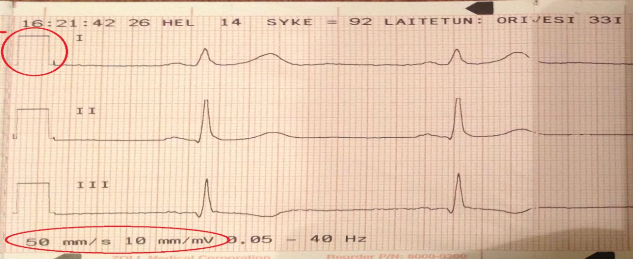 33 sitellaan ihonkäsittelyn kevennettävän. Ihon käsittelystä on harkittava luopumista kokonaan, jos tutkittavan iholla on elektrodien sijoittelukohdilla luomia tai märkäistä ihottumaa.