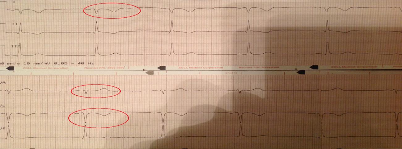 38 KUVA 8. Kuvassa on havaittavissa R-aallon progression rikkoutuminen V3 ja V4 kytkennöissä (punaiset nuolet). Kyseessä on ko. rintaelektrodien johdinten vaihtuminen keskenään.