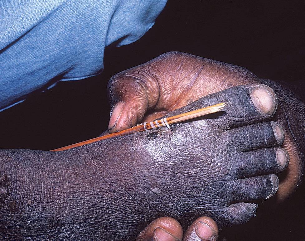 Tiede Yksi ihmisen karmeimmista loismadoista on katoamassa maailmasta Guineanmato on kuuluisa karmeudestaan. Toukat pääsevät elimistöön juomaveden kautta. Naaraat kasvavat jopa metrisiksi.