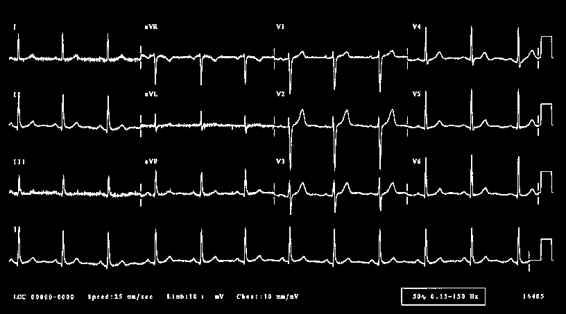 15 Normaalilöydöksenä rekisteröity EKG on esitelty kuvassa 2. Kuva 2. Sinusrytmi (Jenkins & Gerred 2009) 5.4 Tappavat rytmihäiriöt Tappavat rytmihäiriöt käsitteenä kattaa neljä rytmiä.