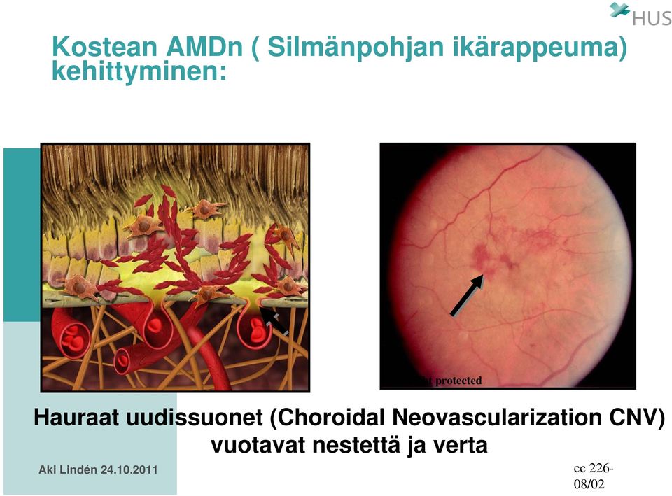 (Choroidal Neovascularization CNV)