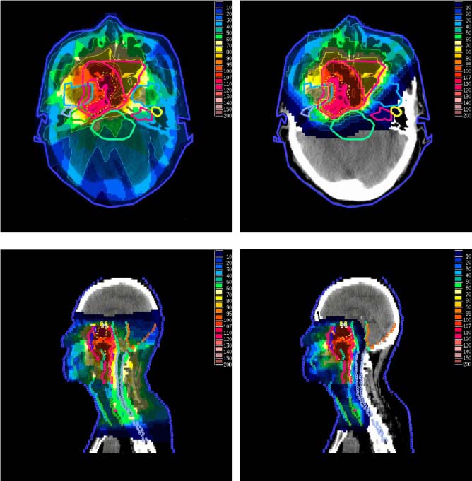 Tutkimusagenda (SRA, versio 1/2014) Vision 4: Towards an integrated personalized dosimetry in medical applications To improve out-of-field dosimetry for photon and particle therapy To develop