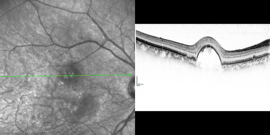 11 Verkkokalvon irtaumassa sensorinen retina irtautuu pigmenttiepiteelistä, jolloin verkkokalvon normaali toiminta häiriintyy ja se alkaa rappeutua. (Saari 2002: 240).