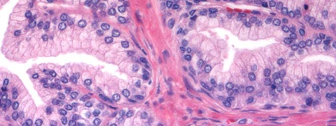 prostata yli