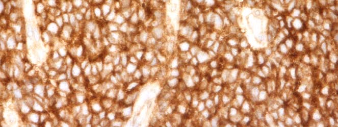 PNET, mediastinum