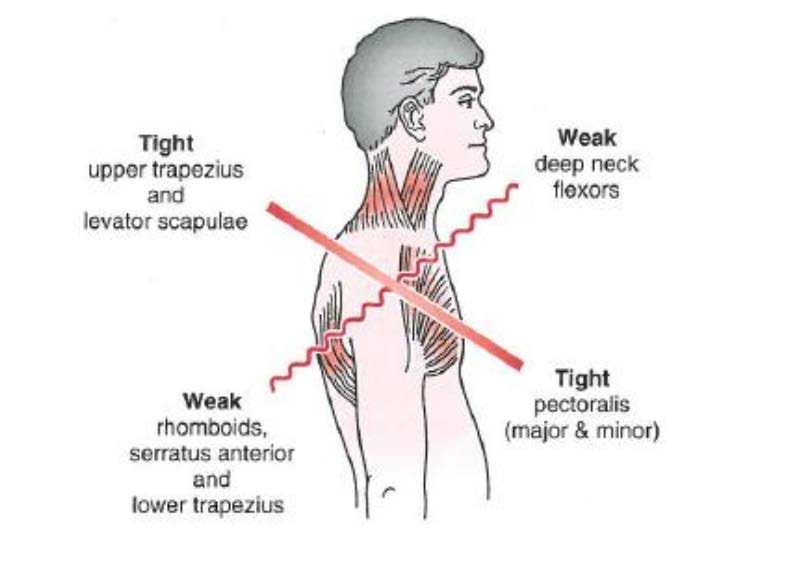 43 KUVIO 10 Upper crossed syndrome. (Magee, D 2008, 145) Lihastasapainon osuus pään ja kaulan asentomuutoksissa on suuri. Heikot ja venyneet kaulan alaosan, kaulan etuosan ja rintakehän yläosan m.