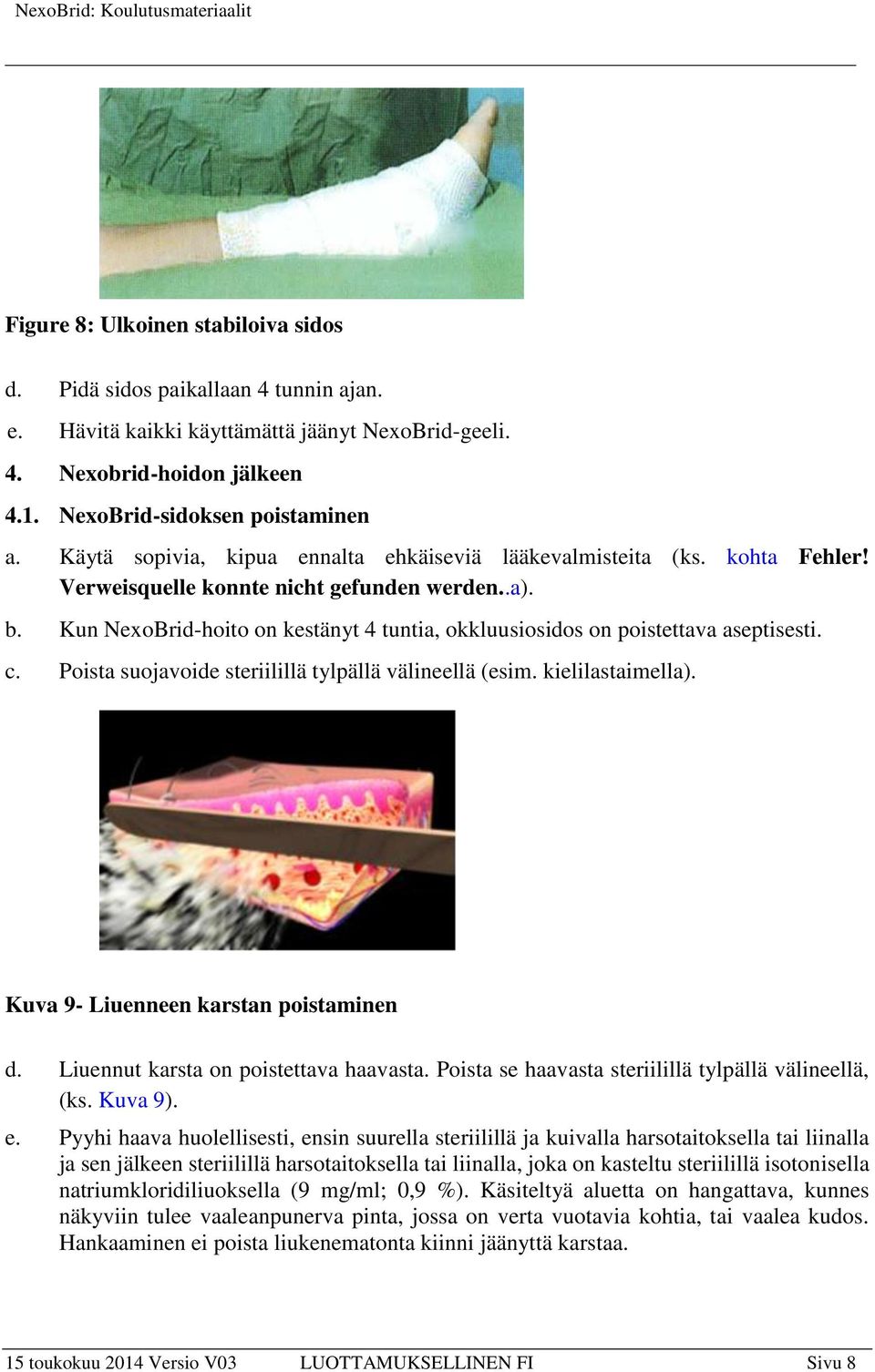 Kun NexoBrid-hoito on kestänyt 4 tuntia, okkluusiosidos on poistettava aseptisesti. c. Poista suojavoide steriilillä tylpällä välineellä (esim. kielilastaimella).