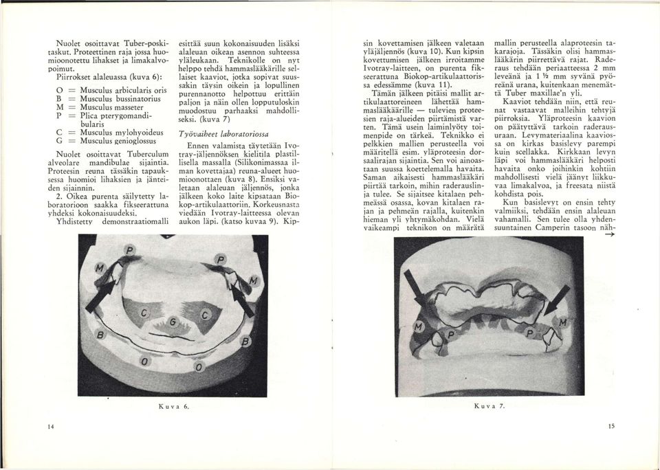 osoittavat Tuhercuium aiveoiare mandihuiae sijaintia. Proteesin reuna tässäkin tapauksessa huomioi lihaksien ja jänteiden sijainnin. 2.