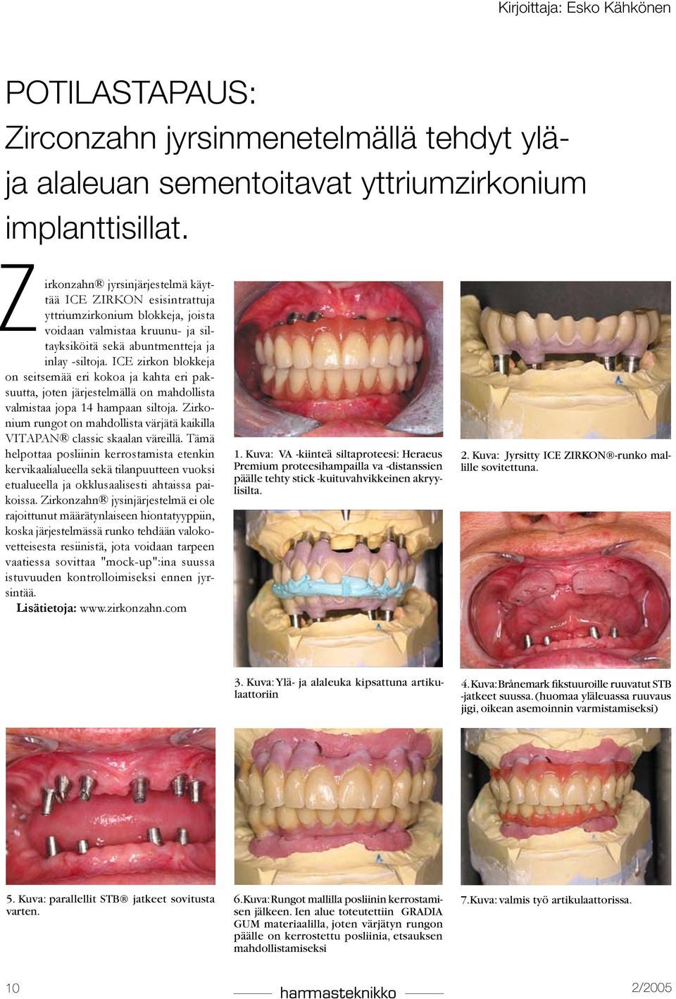 ICE zirkon blokkeja on seitsemää eri kokoa ja kahta eri paksuutta, joten järjestelmällä on mahdollista valmistaa jopa 14 hampaan siltoja.