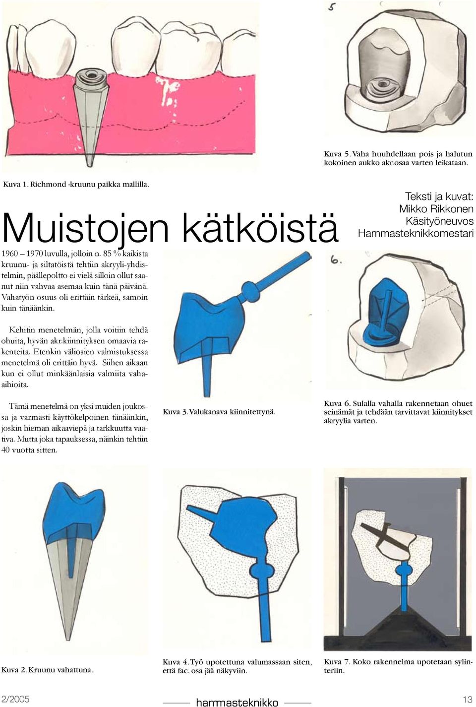 85 % kaikista kruunu- ja siltatöistä tehtiin akryyli-yhdistelmin, päällepoltto ei vielä silloin ollut saanut niin vahvaa asemaa kuin tänä päivänä.