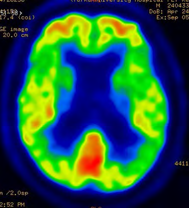 temporaalilohkoihin painottuva hypometabolia,