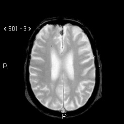 MRI: iän mukaista atrofiaa kortikaalisesti, hippokampusatrofia 3/4,