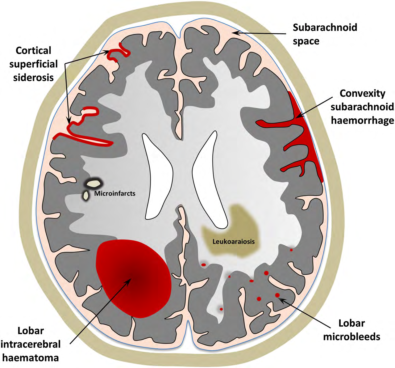 A schematic representation of the spectrum of haemorrhagic and ischaemic manifestations of sporadic cerebral amyloid