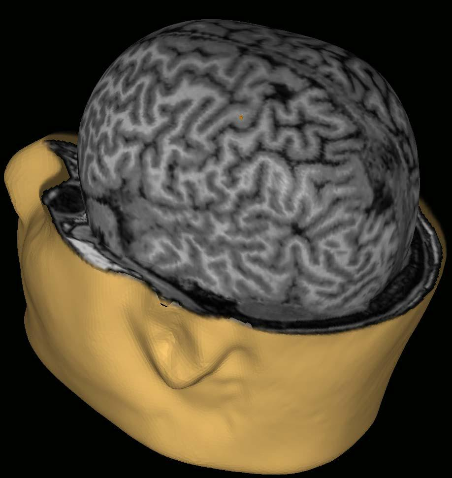 21 TMS 1st stimulus 100% 2nd stimulus 46% 3rd stimulus 58% 4th stimulus 58% 600 µv 50 ms Kuva 6. Kuvassa stimuloitu alue merkitty keltaisella ympyrällä.