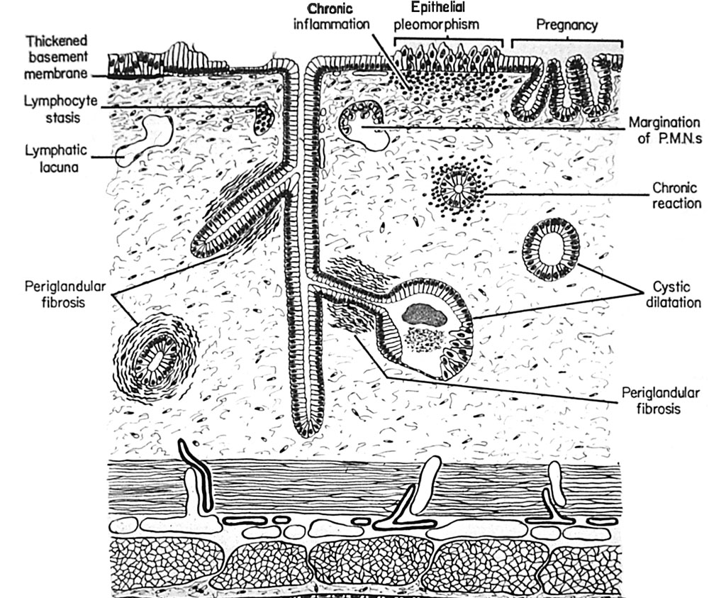 4. Patologiset löydökset tulkittaessa biopsiaa Kiimakierron vaiheen määrityksen jälkeen tutkitaan biopsiasta endometriumin patologiset muutokset järjestelmällisesti etenemällä lumenin sisällön