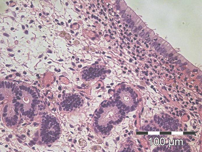 Kuva 4.2 Neutrofiilejä stratum compactumissa diffuusisti, transepiteliaalista migraatiota lumeniin. Kuvassa myös muutamia hemosiderofageja. 4.2 Fibroosi Lamina proprian stroman solut eivät yleensä tuota valomikroskoopissa näkyvää kollageenia.