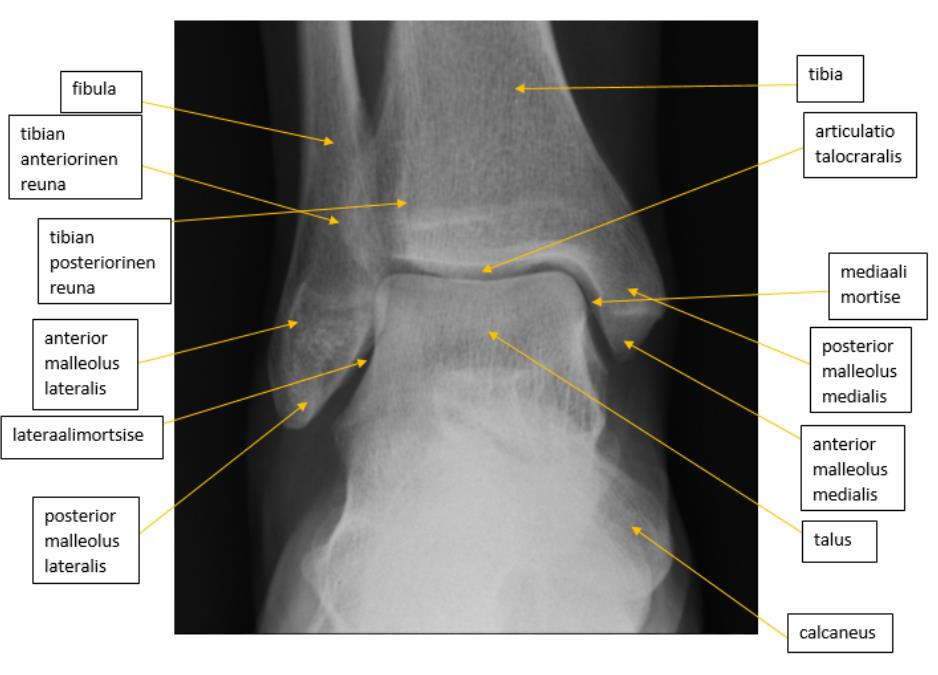 23 4.4 Nilkan luinen anatomia 4.4.1 AP-kuva Anatomisesti suorassa nilkan AP-kuvassa mediaalinen Mortise-nivel on avoin ja sääriluu (tibia) peittää puolet distaalisesta pohjeluusta (fibula).