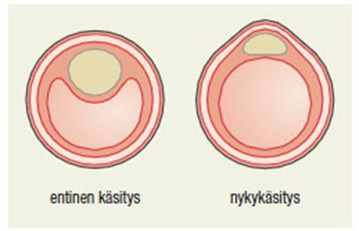 11 KUVA 2. Verisuonten rakenne. (Kettunen 2008b, 31). KUVA 3. Vasen sepelvaltimo. (Kovanen 2008a). Sepelvaltimoiden virtausaukon (luumen) läpimitta on suurimmillaan noin 3 4 mm.