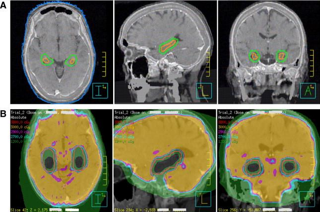 Targeted approach to avoiding the hippocampus.