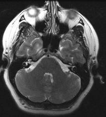 Aivorunko = midrain + pons + medulla 21 Aivorungon sädevaurio vakava vaurio kuukausien vuosien kuluttua hoidosta raportoituina toksisuuksina hemipareesi, ataxia,